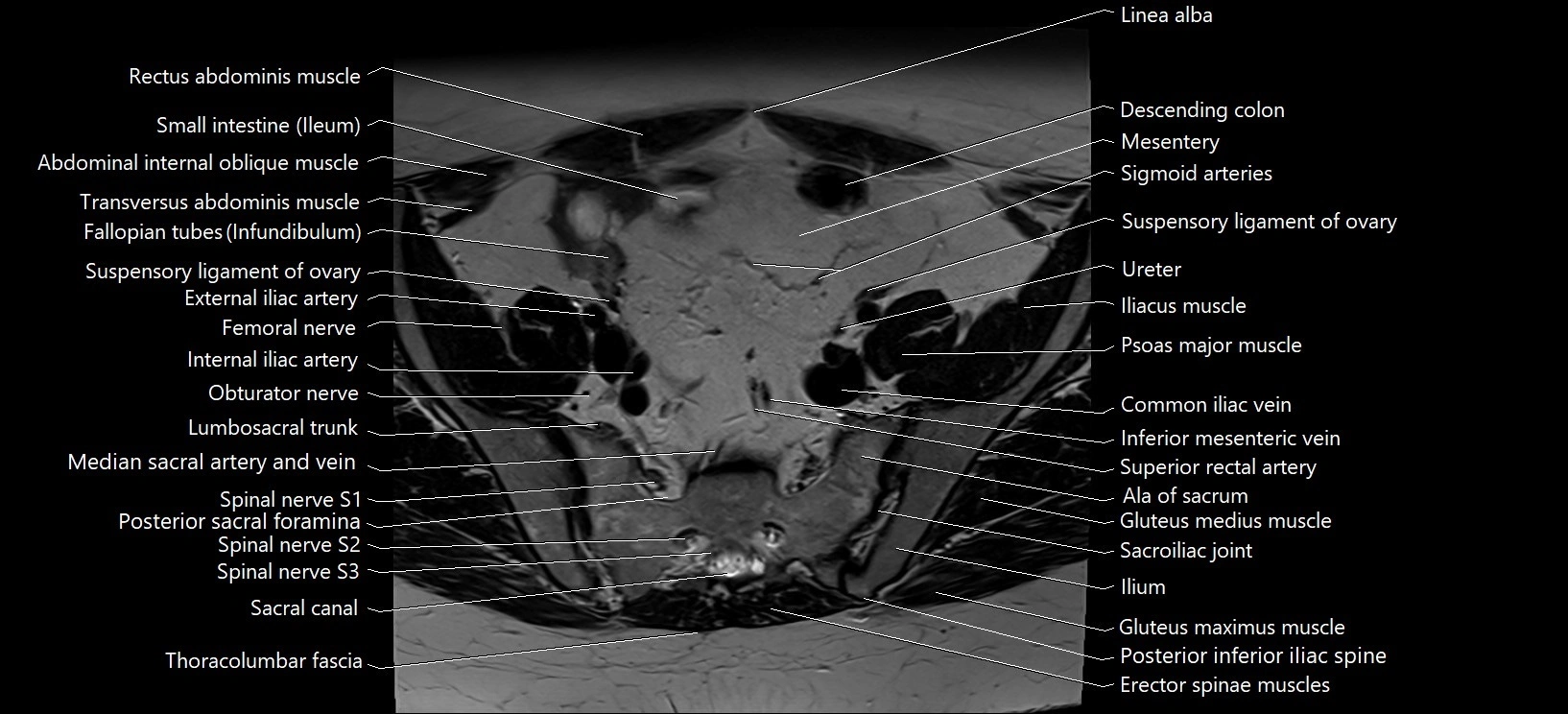 Axial cross sectional anatomy of female pelvis (MRI 3T) image 3.webp